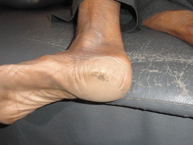 Homoeopathic Treatment for Diabetic Feet Gangreen