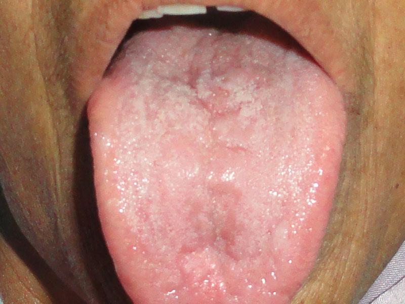 Homoeopathic Treatment for Tongue Cancer