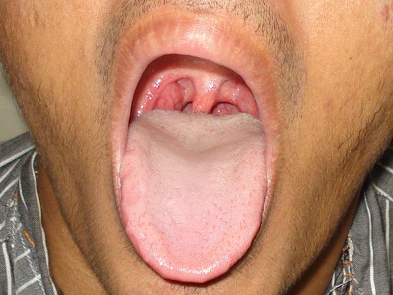 Homoeopathic Treatment for Tonsil