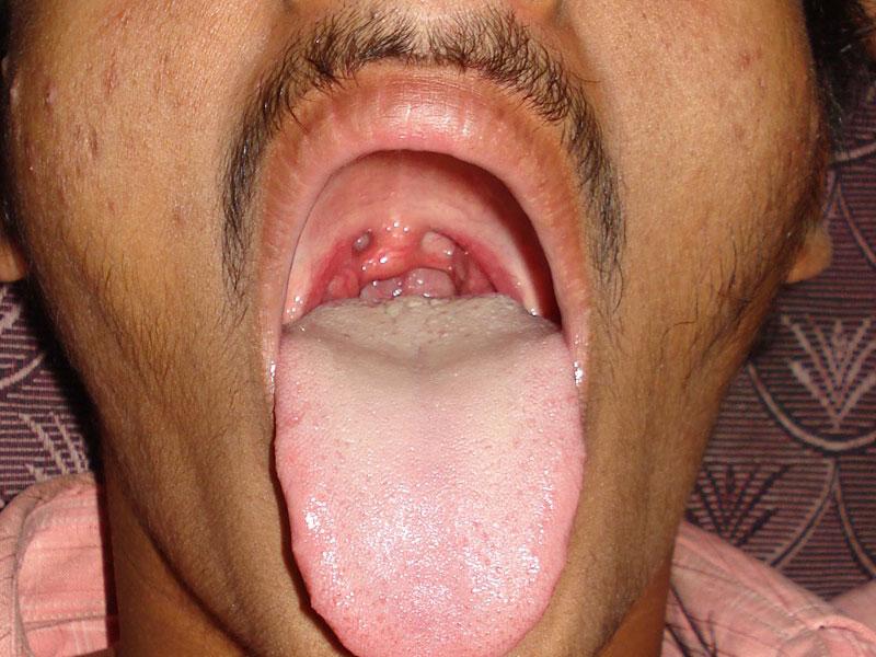 Homoeopathic Treatment for Tonsil
