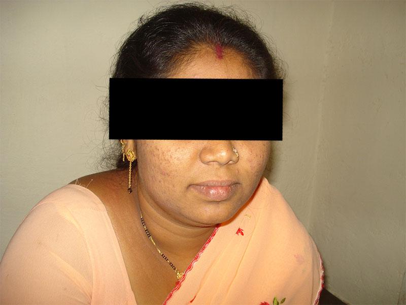Homoeopathic Treatment for Acne Patient Success Story