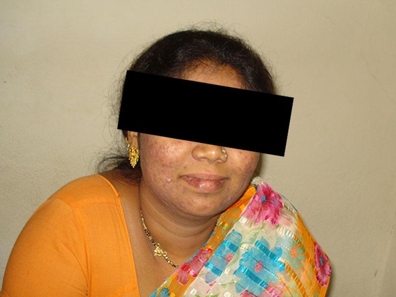 Homoeopathic Treatment for Acne Patient Success Story
