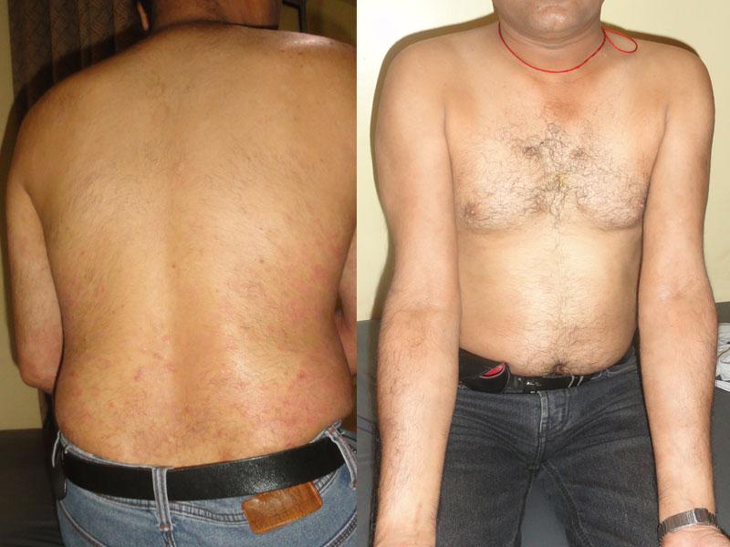 Homoeopathic Treatment for Psoriasis