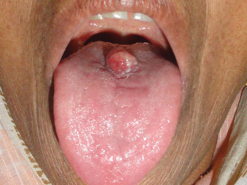 Homoeopathic Treatment for Tongue Cancer